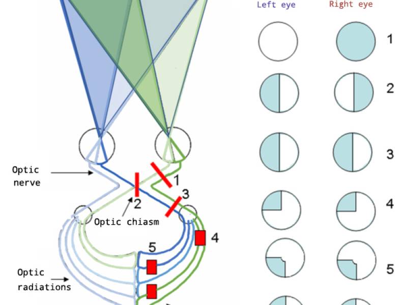 visual-fields.jpg